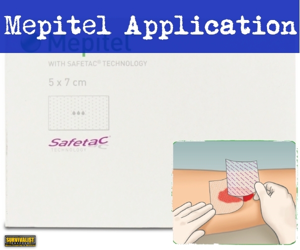 Mepital Application